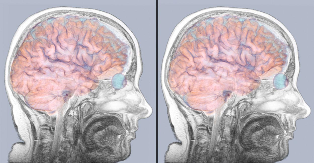 Поражение головного мозга при инсульте. Вазогенный отек головного мозга. Отек головного мозга патанатомия. Атрофия головного мозга патанатомия.